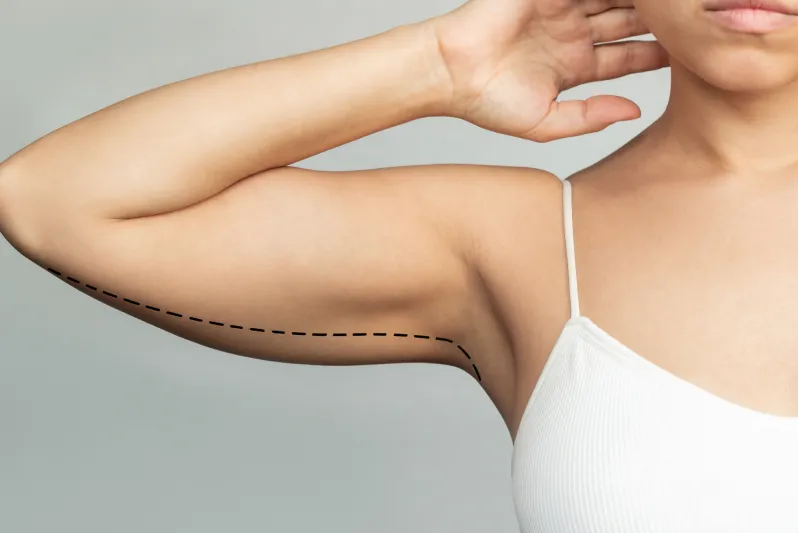 Why Choose This Upper Arm Fat Treatment?