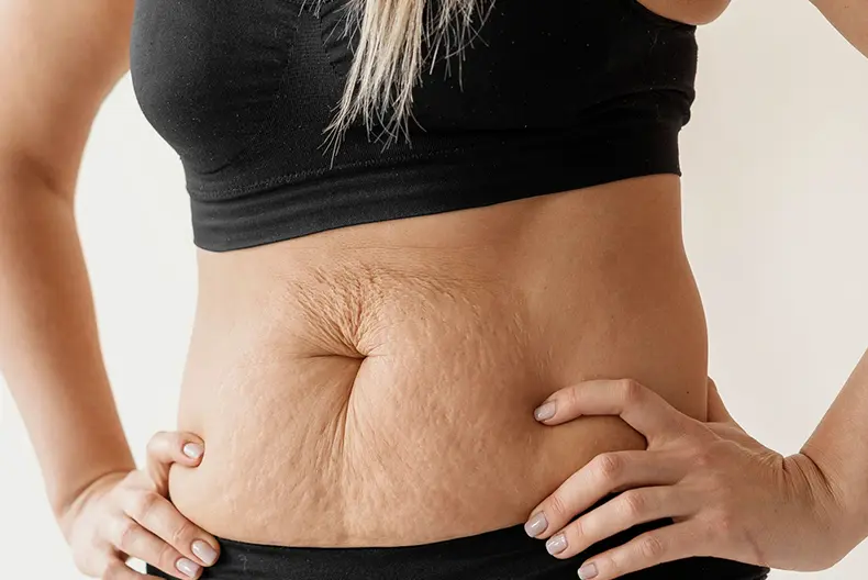 Why Choose This Post Pregnancy Fat Treatment?