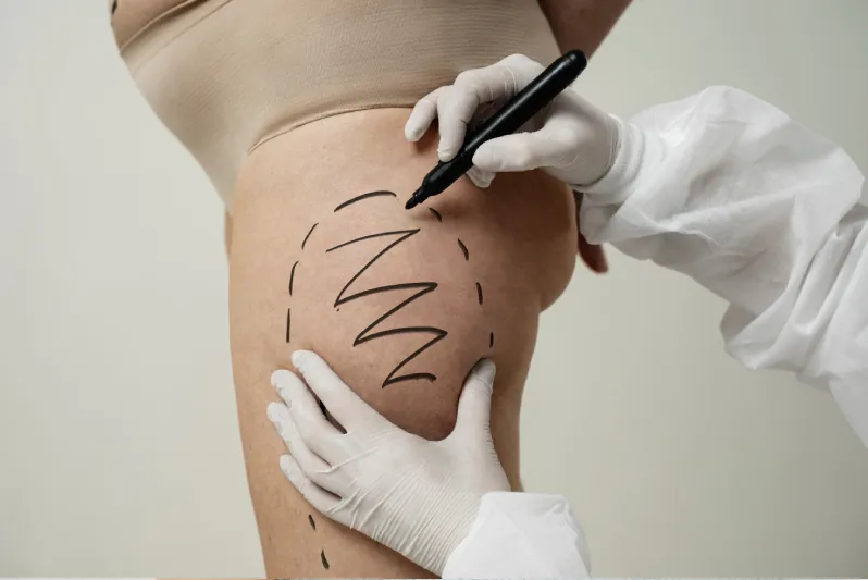 Why Choose This Thigh Fat Treatment?